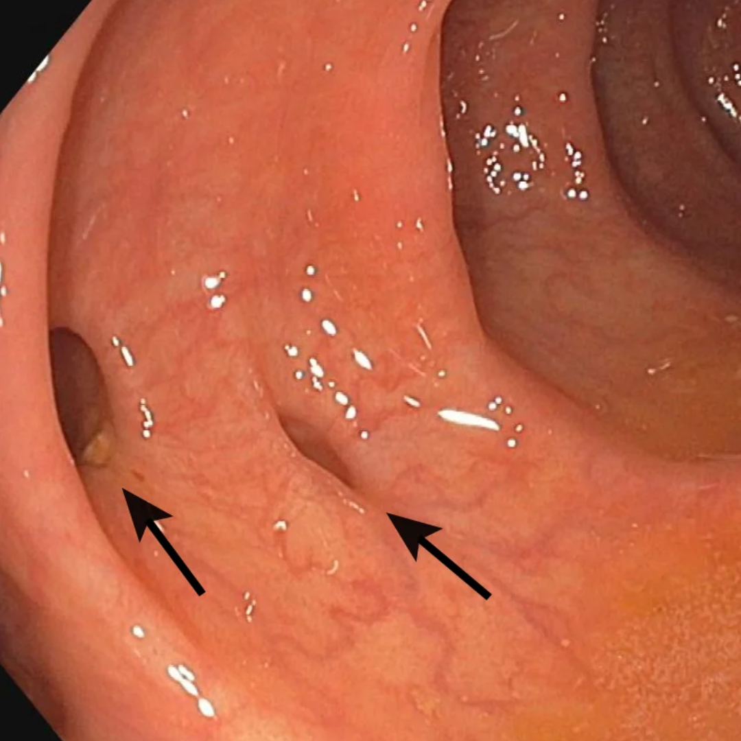 Diverticular Disease | Core Surgery | Dr Vasant Rajan - Colorectal Surgeon | Capalaba | Upper Mt Gravatt | Brisbane